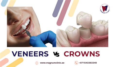 Veneers VS Crowns - pros and cons, difference between veneers and crowns