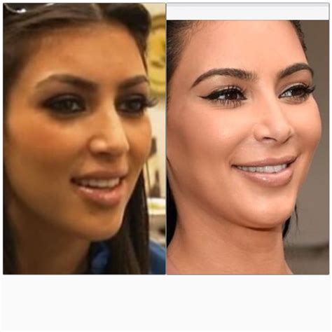 Kim kardashian nose job | Nose job, Rhinoplasty nose jobs, Celebrity plastic surgery