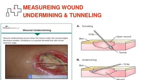 tunneling wound vs undermining - Caption Simple