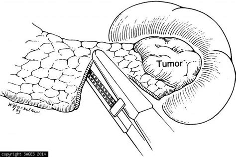 Fundamentals: Distal Pancreatectomy Categories - SAGES