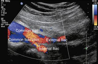 Common Iliac Artery Ultrasound