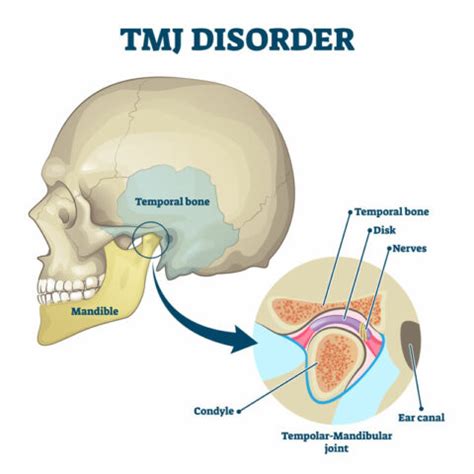 About TMJ Disorder - TMJ Pain Solutions