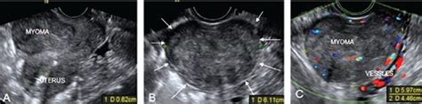 Serosal fibroid image shown under sonography. A) Transvaginal... | Download Scientific Diagram