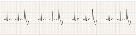 EKG Monitor Showing Sinus Rhythm with Trigeminy PVC 35372509 Vector Art ...