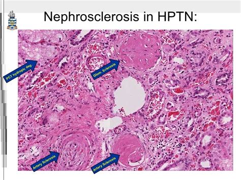 hypertensive nephrosclerosis kidney histology