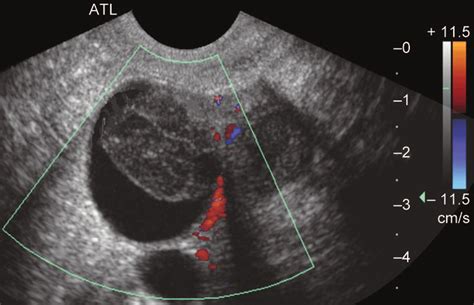 Transvaginal ultrasound of the adnexa. Note cystic structure with a... | Download Scientific Diagram