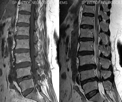 Dr Balaji Anvekar FRCR: Intradiscal Vacuum Phenomenon