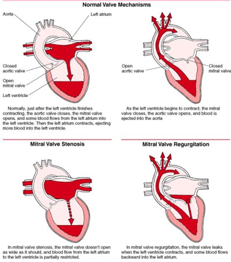 Mitral Valve Repair | Minimally Invasive Heart Surgery