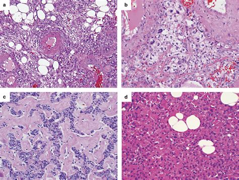 Tumors that were excluded from the study. (a) Classic angiomyolipoma... | Download Scientific ...