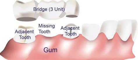 Selecting Different Types of Dental Bridges | Gentle Breeze Dental