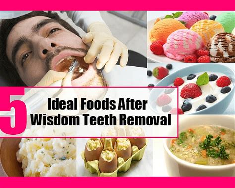 Best Foods to Eat After Tooth Extraction & Wisdom Tooth Removal