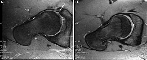 FemoroAcetabular Impingement - Robert Howells