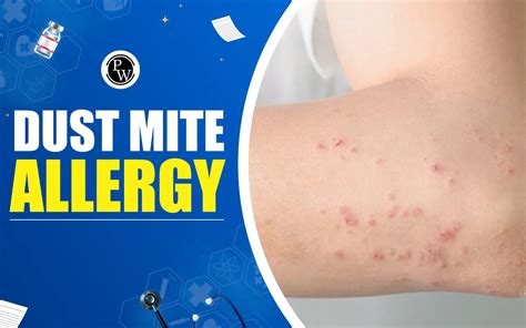 Dust Mite Allergy: Symptoms, Complications, And Treatment