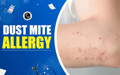 Dust Mite Allergy: Symptoms, Complications, And Treatment