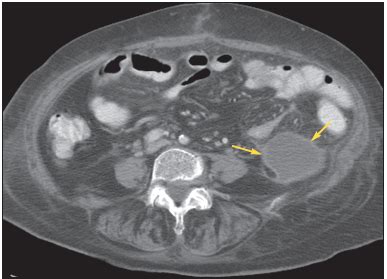 Photoclinic: Postoperative Intra-abdominal Abscess | Consultant360