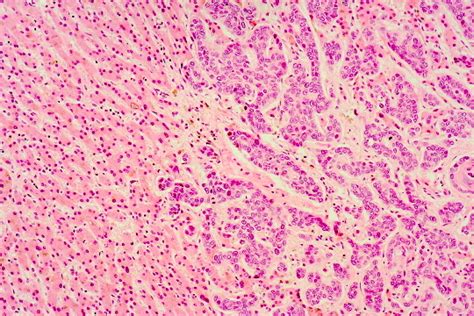 Hepatic Pathology