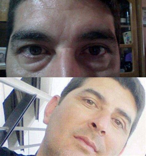 Post Male Blepharoplasty Chemosis Treatment » Eyelid Surgery: Cost ...