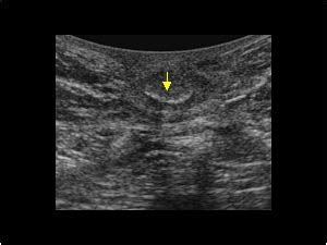 Omphalomesenteric Duct Remnants