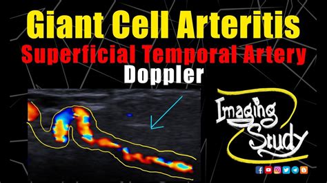 Temporal Artery Ultrasound