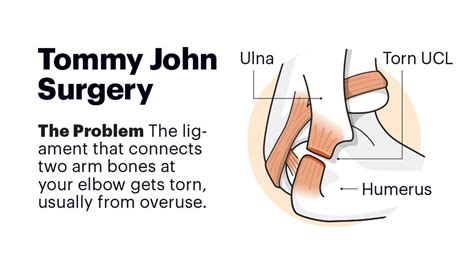 Why Tommy John Is Against the Surgery Named for Him