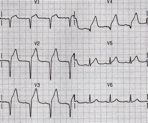 Coronary Artery Disease: Clinical Case