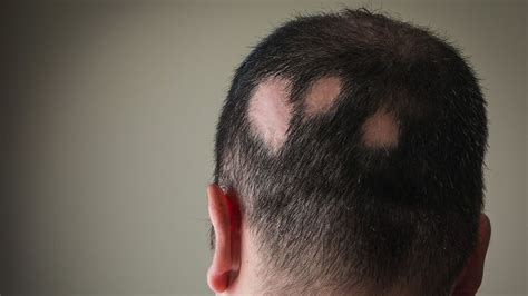 Alopecia Areata and Hair Loss: Causes, Symptoms, Treatment – The Amino Company