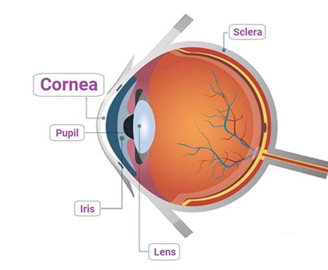 Cornea Transplant