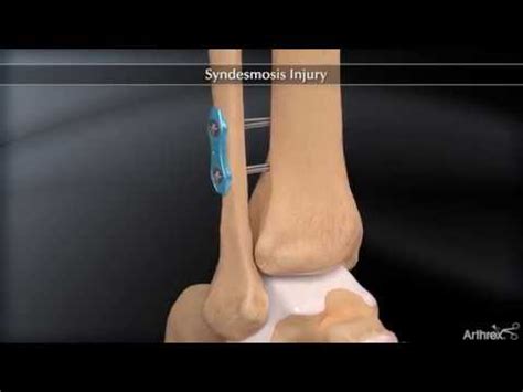 Syndesmosis Injury - YouTube