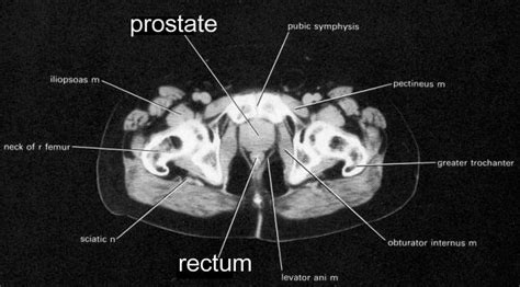 Prostate Imaging