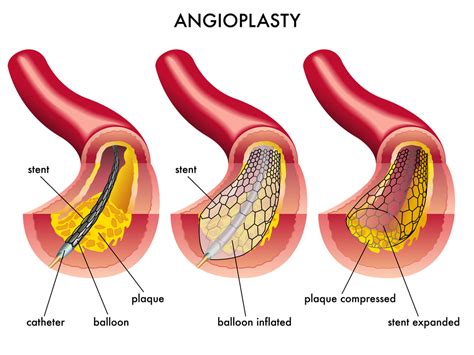 Balloon Angioplasty Procedure for Peripheral Artery Disease