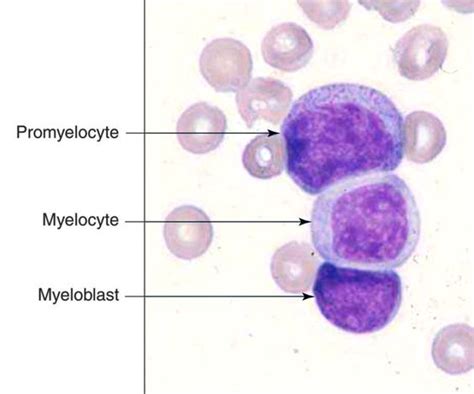 Myeloblast : Highest N/C ratio - Finest nuclear chromatin pattern ||| Promyelocyte : Presence of ...