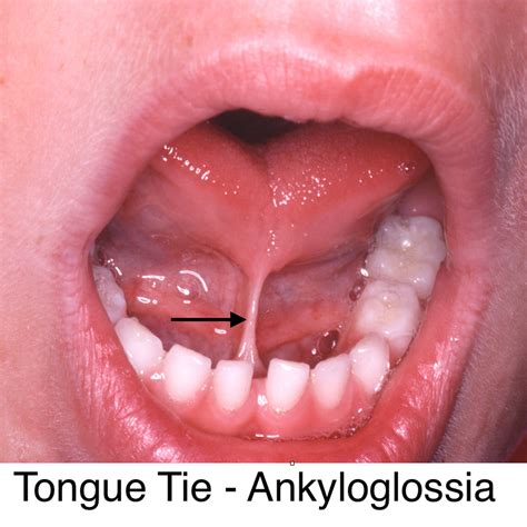 Tongue Tie and Lip Tie (Frenectomy) - Lonestar Kid’s Dentistry