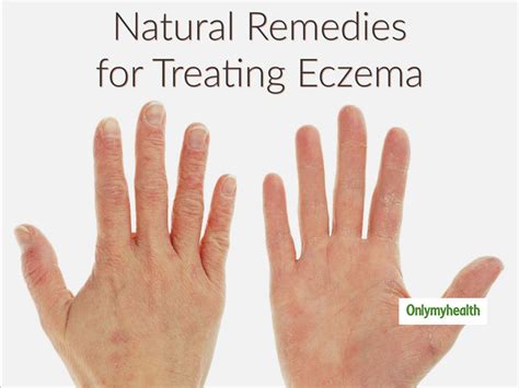 Eczema Home Remedy: Treating Eczema Naturally with Echinacea | OnlyMyHealth