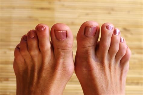 Cures for Thick Yellow Toenails | Healthfully