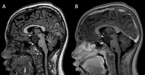 Figure 2 from MR imaging of hypothalamic hamartoma in a patient with ...