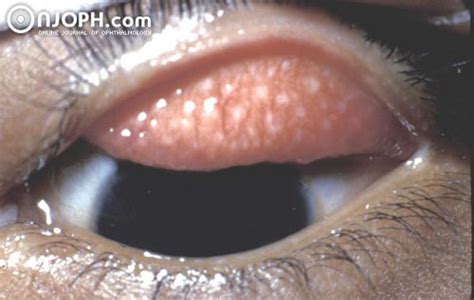 Trachoma | canbiology