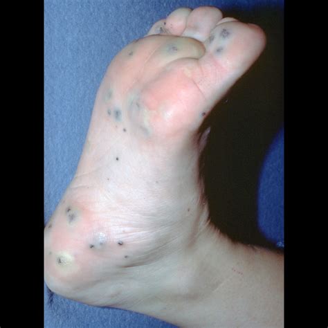 Blue Rubber Bleb Nevus Syndrome | Pediatric Radiology Reference Article ...