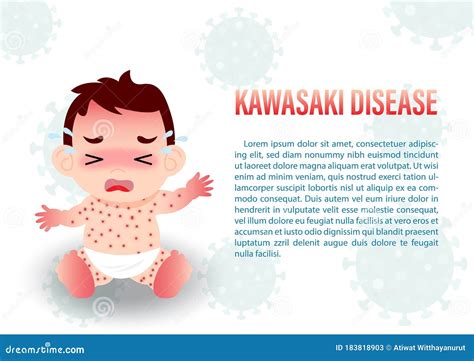 KAWASAKI DISEASE Also Known As Kawasaki Syndrome Mucocutaneous Lymph Node Syndrome Royalty-Free ...