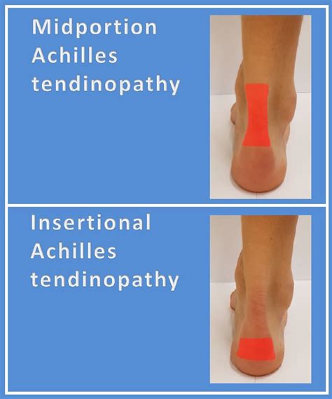 Which treatment is most effective for Achilles tendinopathy? A new way of finding out! - BJSM ...