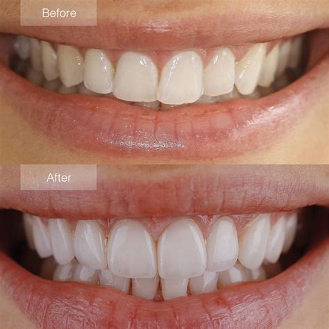 Porcelain Veneers Before and After - The Dental Room