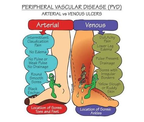 Peripheral Arterial Disease Vs Venous Disease - PELAJARAN