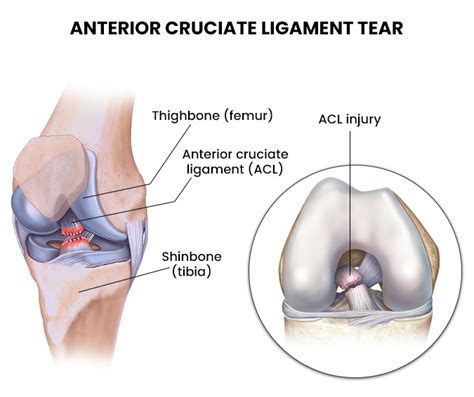 ACL Injuries - NJ's Top Orthopedic Spine & Pain Management Center