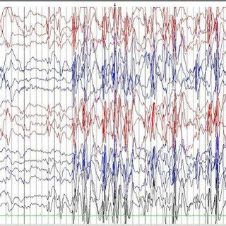 (PDF) Landau-Kleffner syndrome-A rare experience