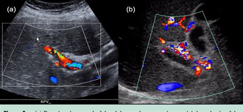 Figure 5 from Portal vein thrombosis. | Semantic Scholar