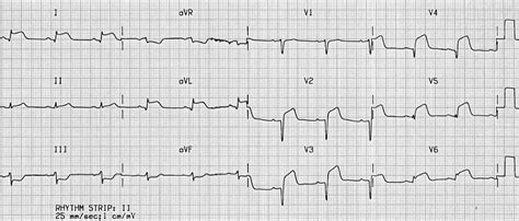 Lateral STEMI ECG changes • LITFL • ECG Library Diagnosis