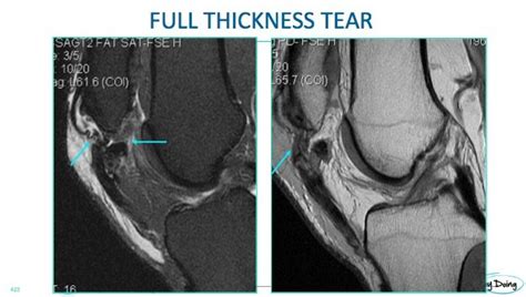 Patella Tendinosis and Tears What to look for on MRI - Radedasia