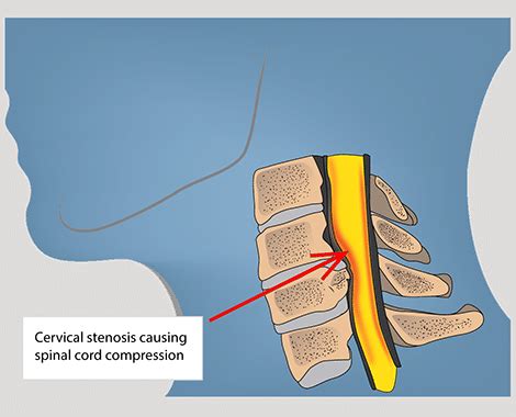 What is Myelopathy? Symptoms & Treatment | Spine & Orthopedic Center