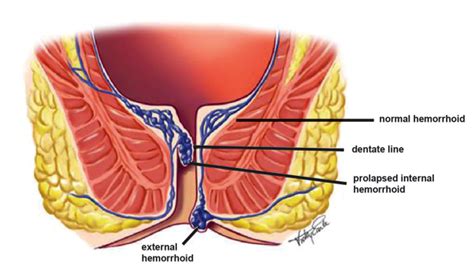 Hemorrhoid Signs & Symptoms - East Valley Hemorrhoid Center