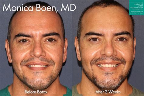 Botox Aftercare: What You Need to Know - Cosmetic Laser Dermatology ...