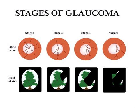 Glaucoma Simulation